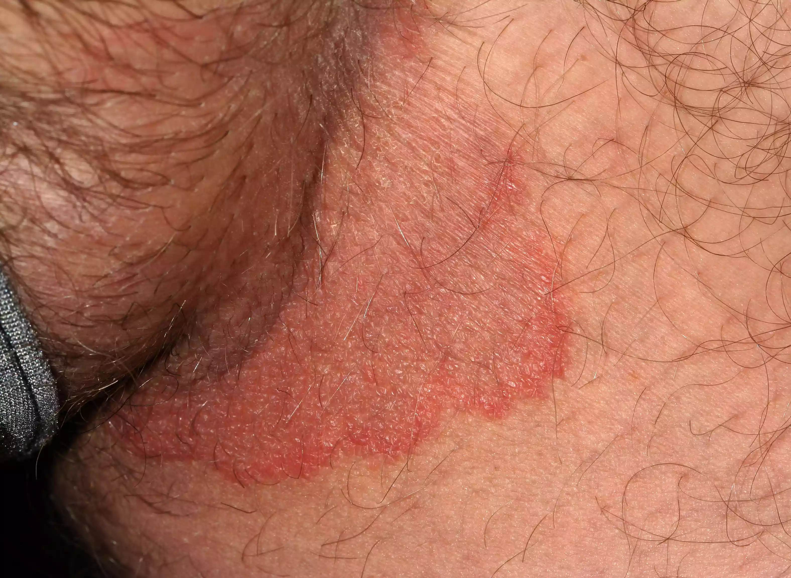 Clinical close-up of Tinea Cruris or jock itch affecting the groin skin.