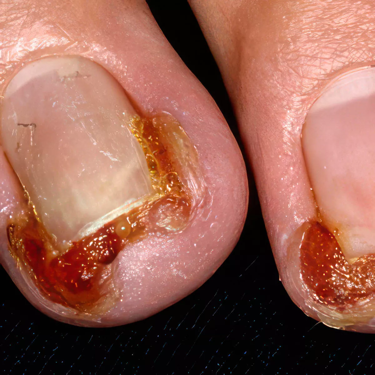 A clinical photograph of inflammatory skin tissue used to represent systemic health markers.