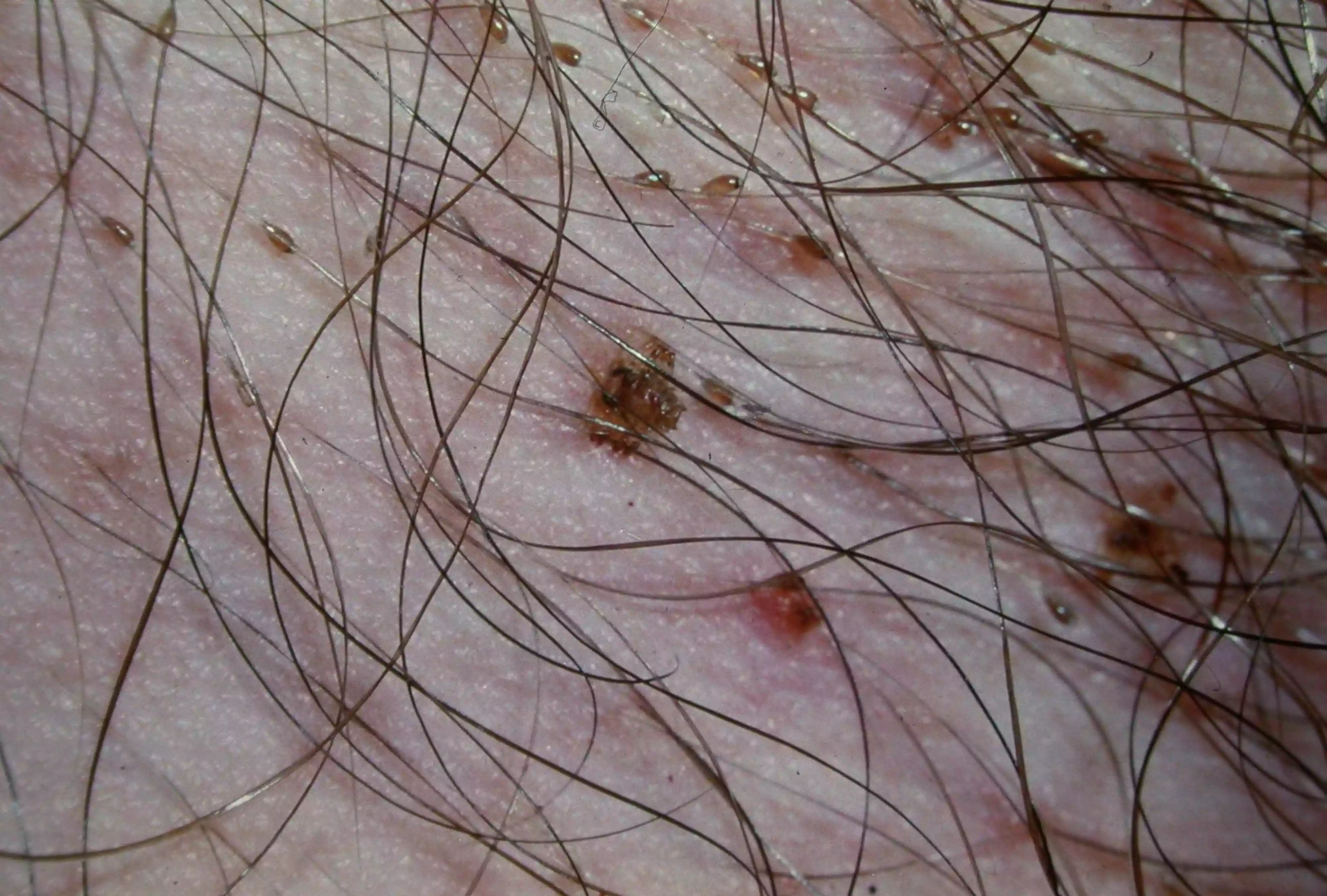 Pubic lice visible on skin with pubic hair.
