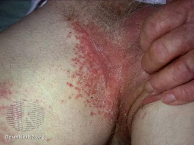 Close-up view of candida intertrigo showing red, inflamed skin folds.