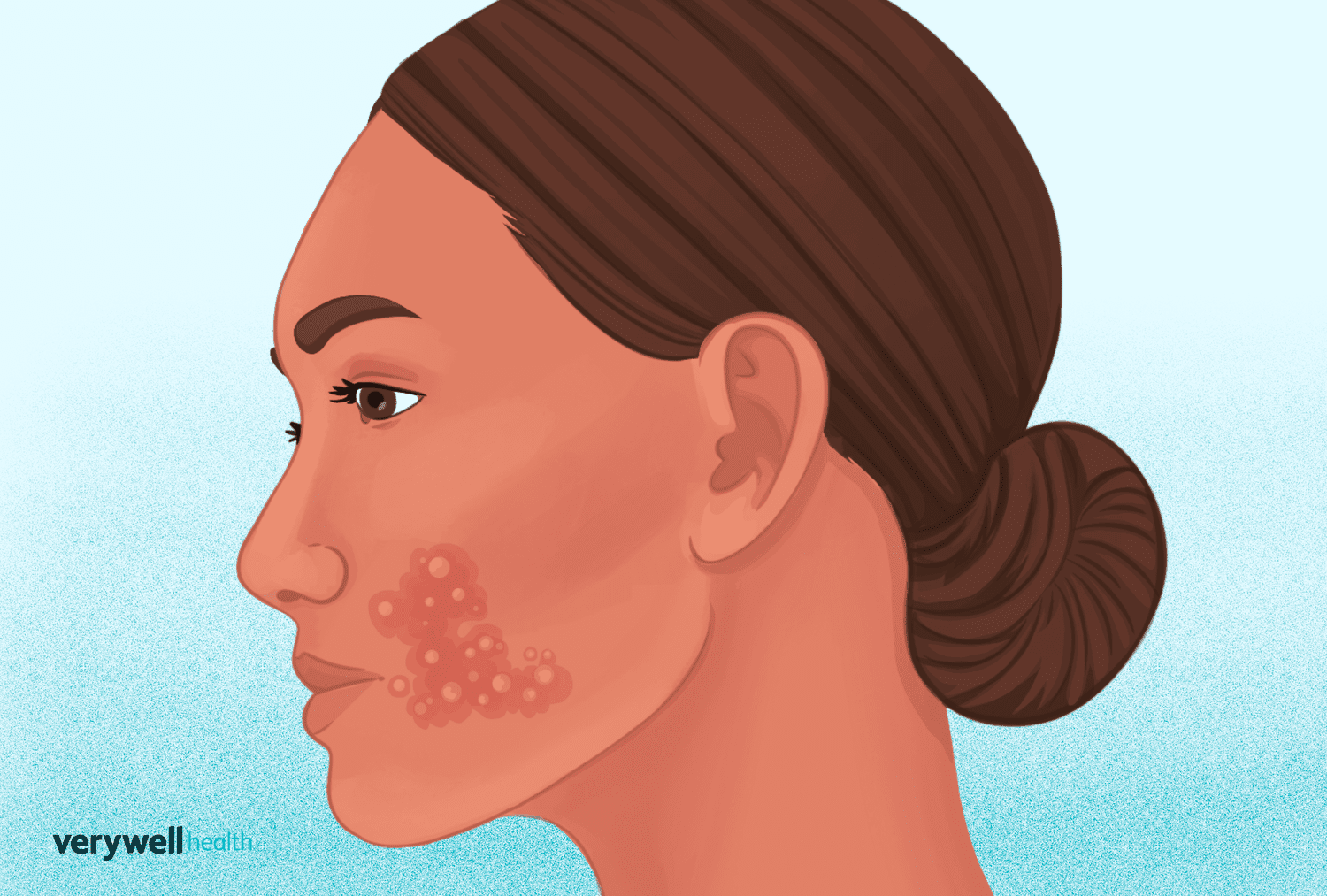 Herpes Discharge: Symptoms and Causes in Men