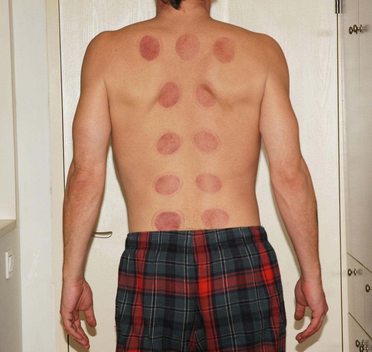 A professional acupuncturist placing fine needles on a patient's face for skin rejuvenation.