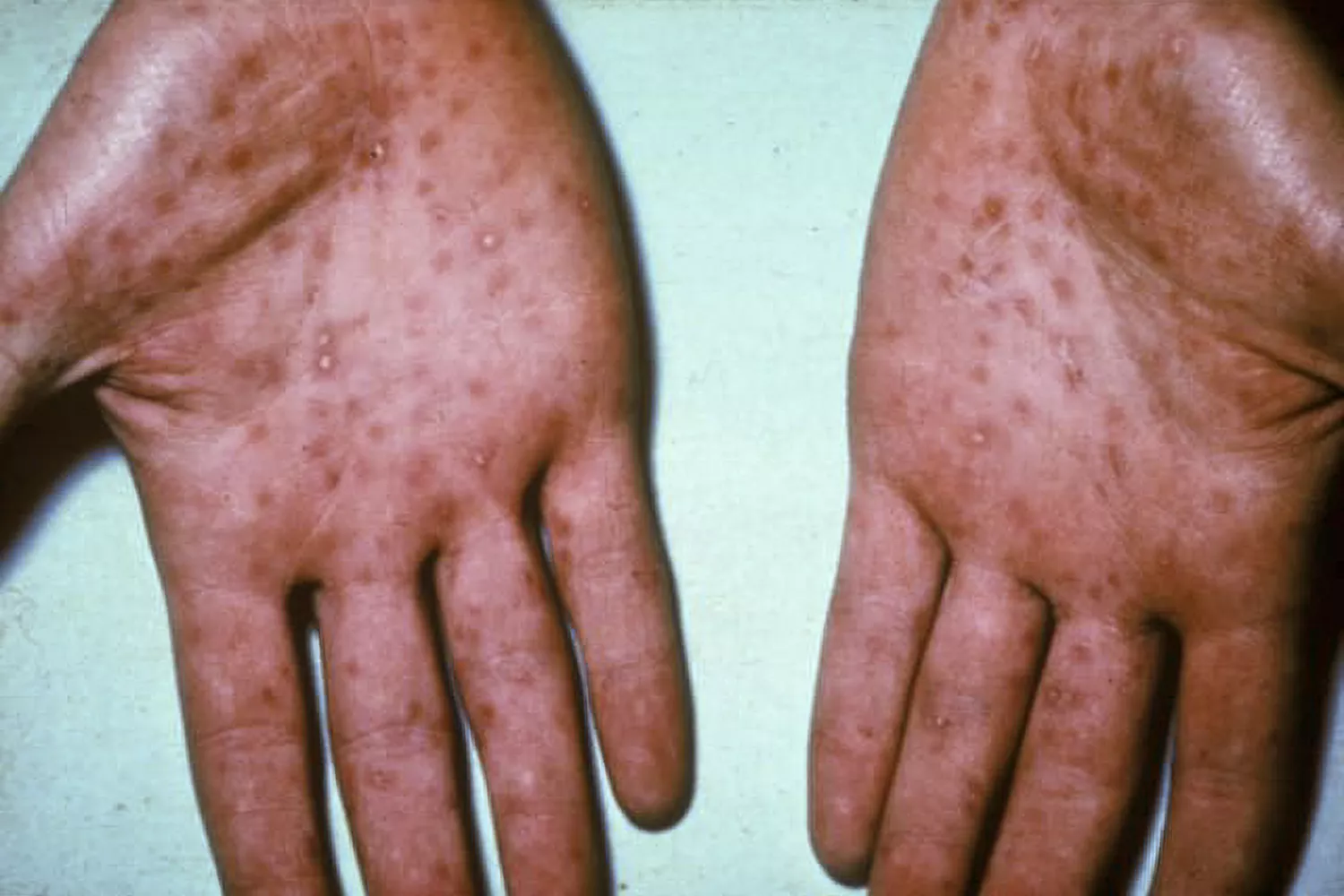 Close-up clinical view of small red papules and lesions on the palms of a person's hands.